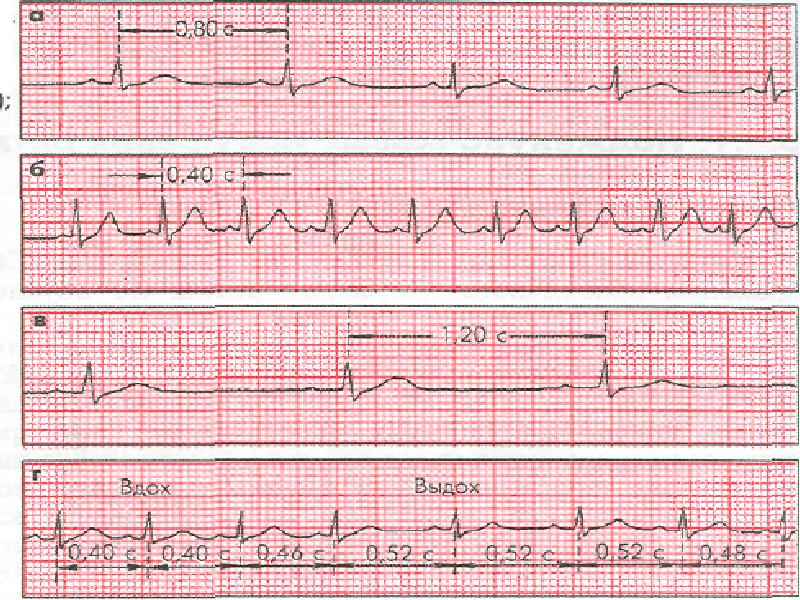 Аритмия на экг фото