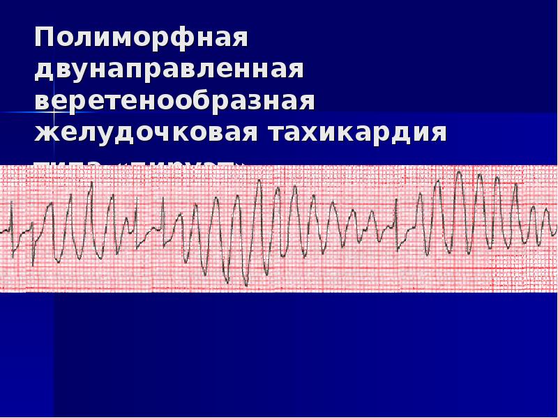 Желудочковая тахикардия картинки