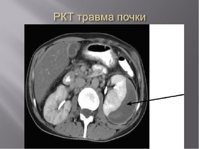 Кт с контрастом. Кт опухоль почек с контрастированием кт. Субкапсулярная гематома почки кт. Опухоль почки на кт с контрастом.