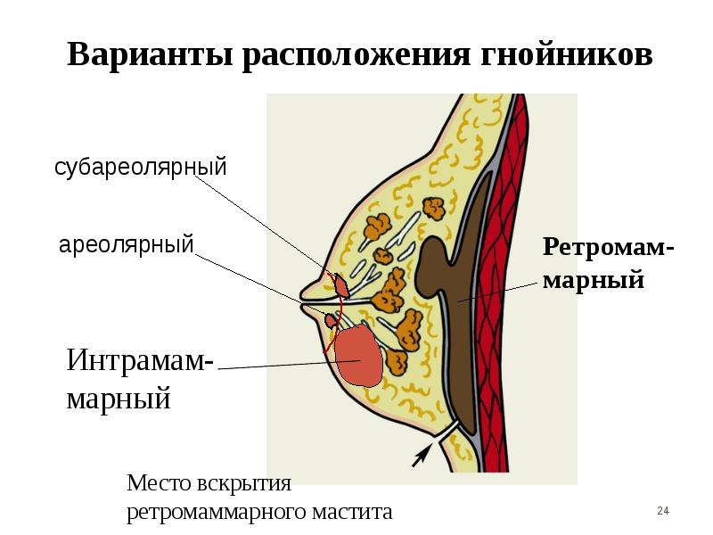 Острый мастит презентация