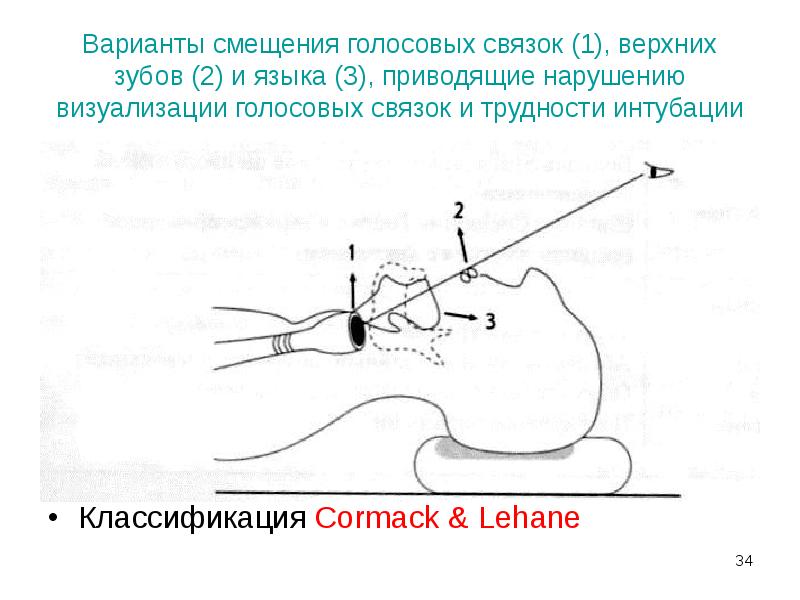 Варианты смещения голосовых связок (1), верхних зубов (2) и языка (3), Варианты смещения голосовых связок (1), верхних зубов (2) и языка (3),
