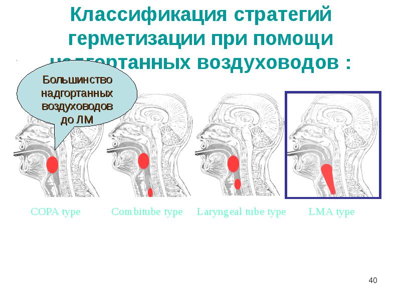 Классификация стратегий герметизации при помощи надгортанных воздуховодов : Классификация стратегий герметизации при помощи надгортанных воздуховодов :