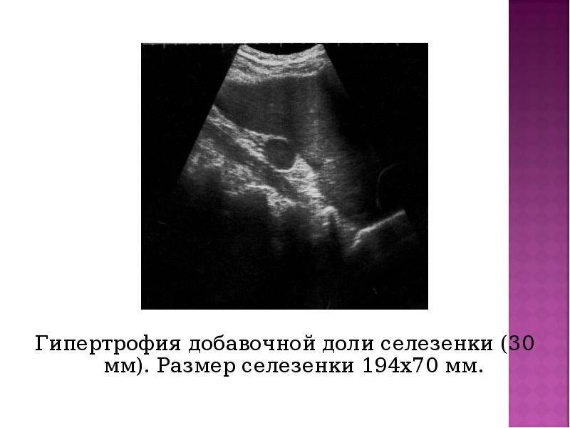 Гипертрофия добавочной доли селезенки (30 мм). Размер селезенки 194х70 мм. Гипертрофия