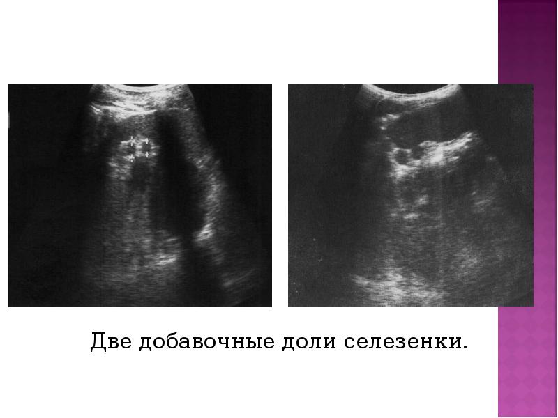 Две добавочные доли селезенки. Две добавочные доли селезенки.