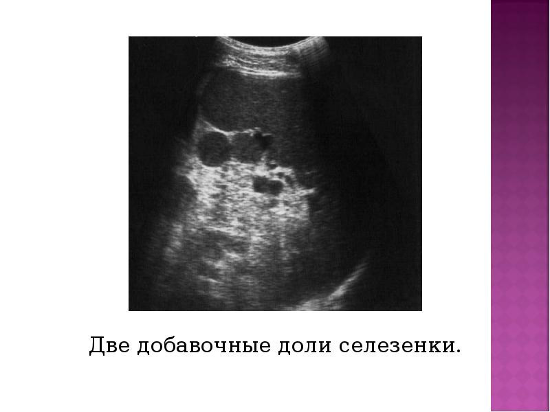 Две добавочные доли селезенки. Две добавочные доли селезенки.