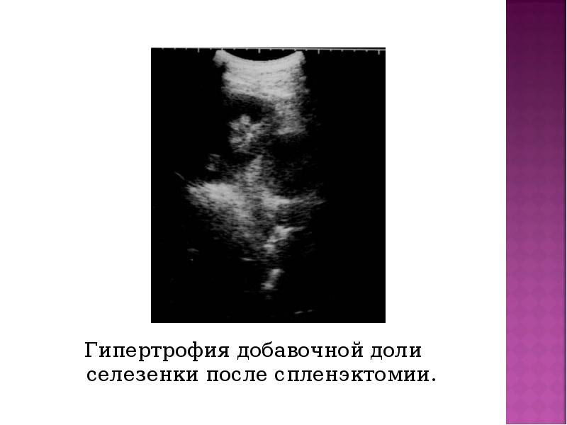 Гипертрофия добавочной доли селезенки после спленэктомии. Гипертрофия добавочной доли селезенки после