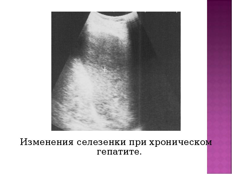 Изменения селезенки при хроническом гепатите. Изменения селезенки при хроническом гепатите.
