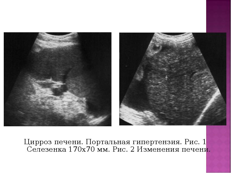 Цирроз печени. Портальная гипертензия. Рис. 1 Селезенка 170х70 мм. Рис. 2