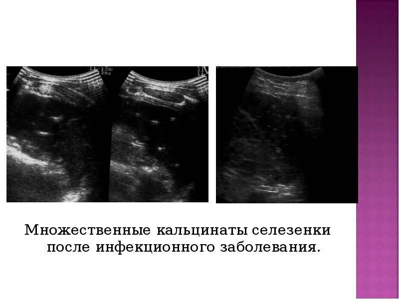 Множественные кальцинаты селезенки после инфекционного заболевания. Множественные кальцинаты селезенки после инфекционного