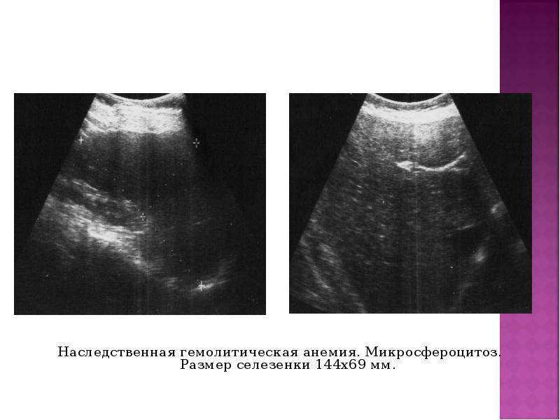 Наследственная гемолитическая анемия. Микросфероцитоз. Размер селезенки 144х69 мм. Наследственная гемолитическая анемия.