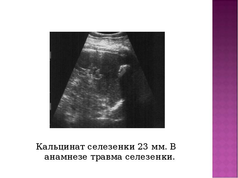 Кальцинат селезенки 23 мм. В анамнезе травма селезенки. Кальцинат селезенки 23
