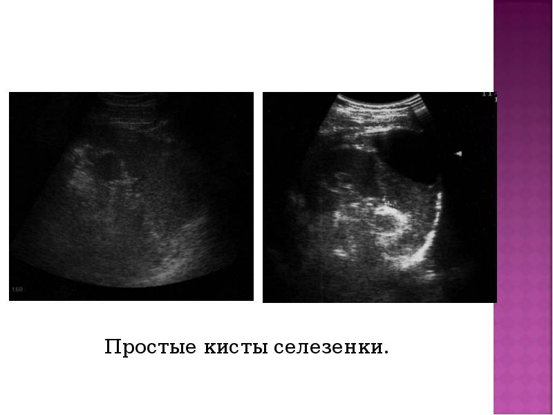 Простые кисты селезенки. Простые кисты селезенки.