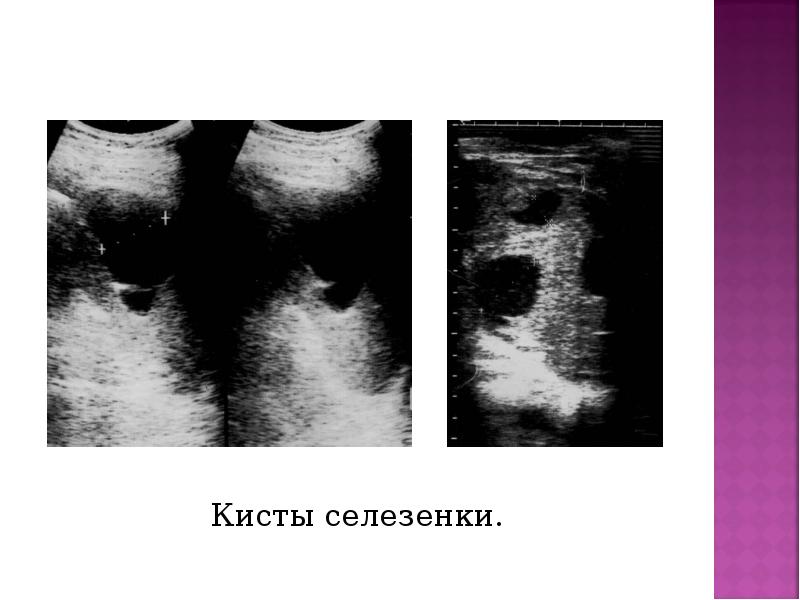 Кисты селезенки. Кисты селезенки.
