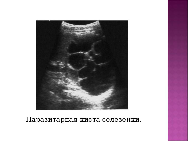 Паразитарная киста селезенки. Паразитарная киста селезенки.