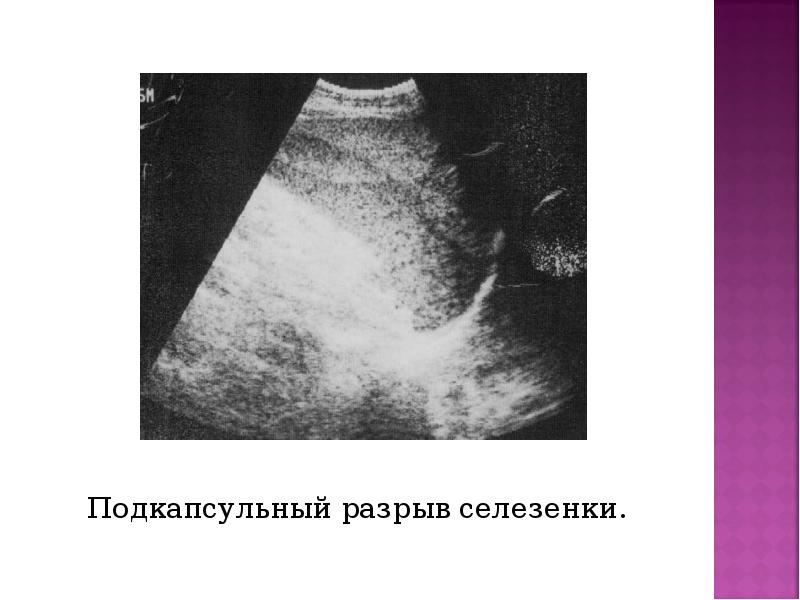 Подкапсульный разрыв селезенки. Подкапсульный разрыв селезенки.