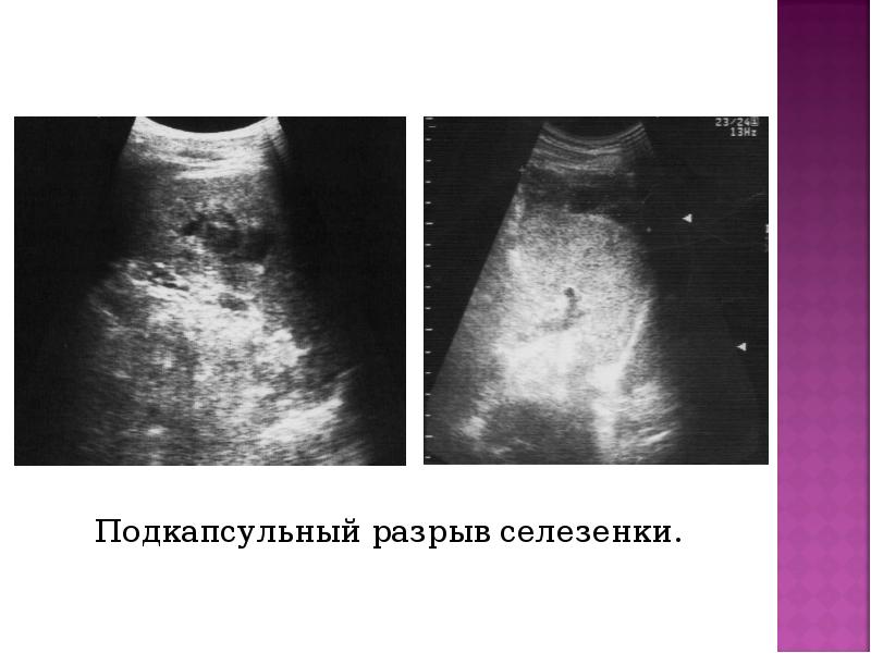 Подкапсульный разрыв селезенки. Подкапсульный разрыв селезенки.