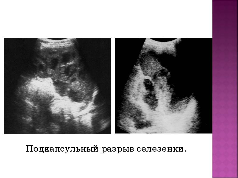 Разрыв селезенки на узи фото