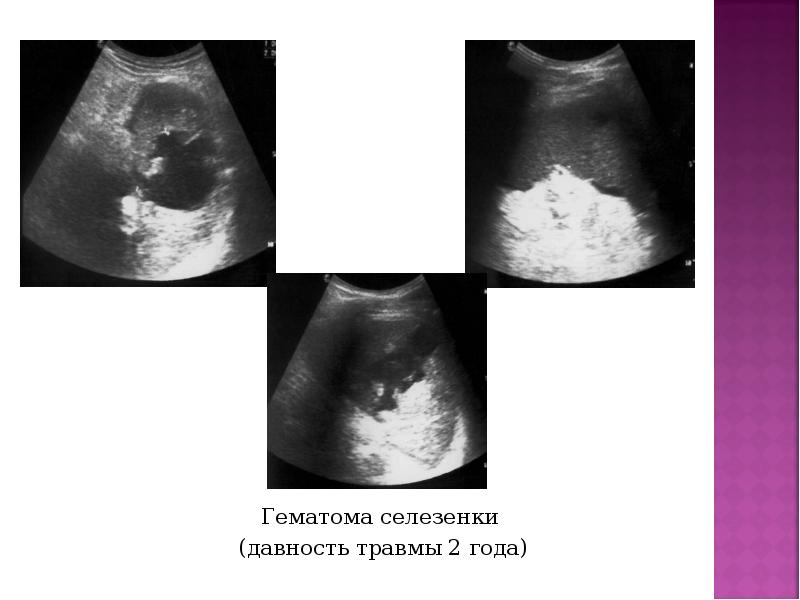 Гематома селезенки  Гематома селезенки  (давность травмы 2 года)