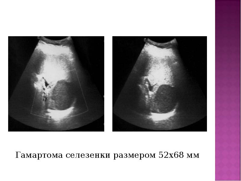 Гамартома селезенки размером 52х68 мм Гамартома селезенки размером 52х68 мм