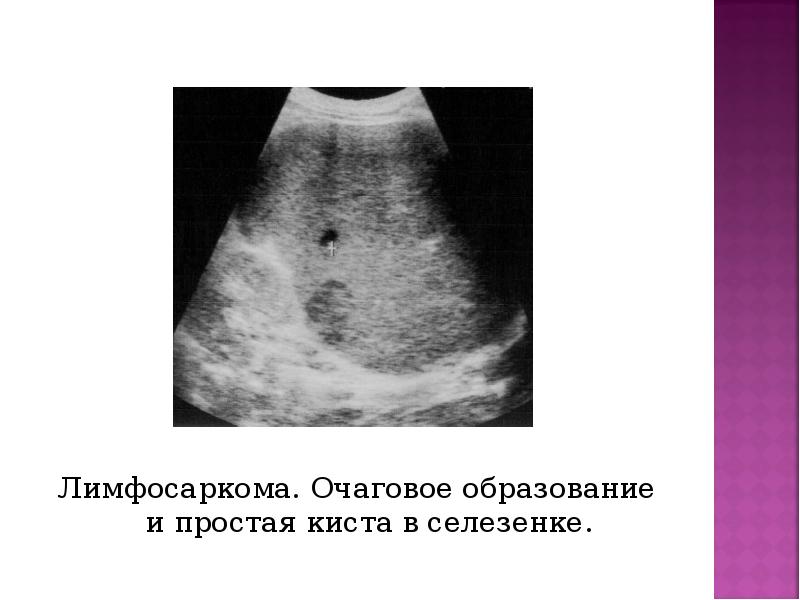 Лимфосаркома. Очаговое образование и простая киста в селезенке. Лимфосаркома. Очаговое образование