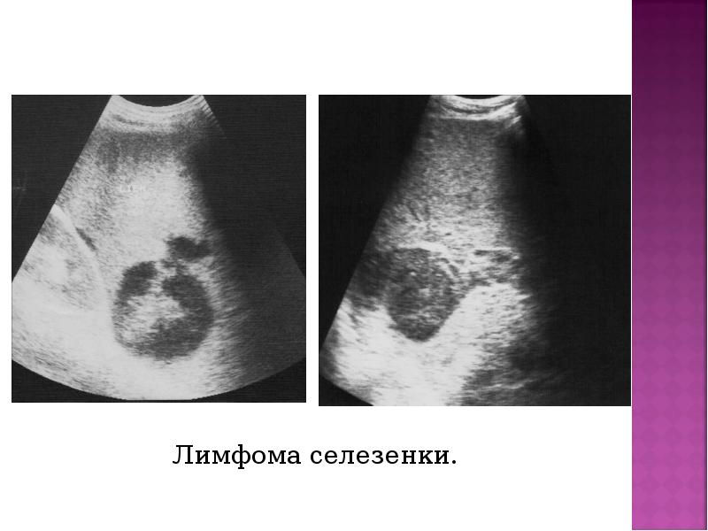 Лимфома селезенки. Лимфома селезенки.