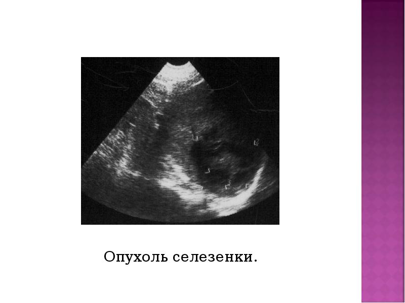 Опухоль селезенки. Опухоль селезенки.