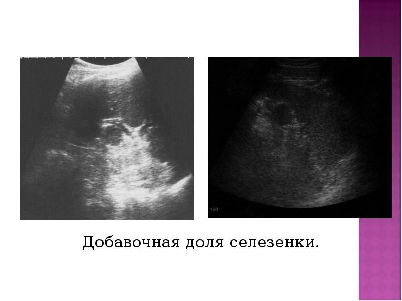 Добавочная доля селезенки. Добавочная доля селезенки.