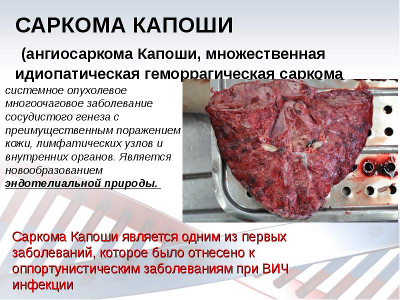САРКОМА КАПОШИ  (ангиосаркома Капоши, множественная идиопатическая геморрагическая саркома