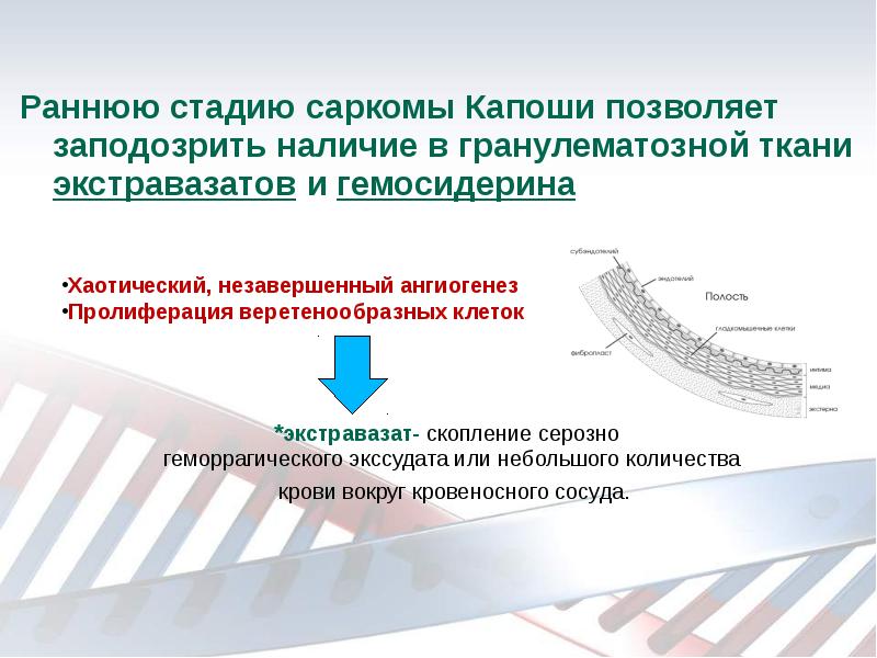 Раннюю стадию саркомы Капоши позволяет заподозрить наличие в гранулематозной ткани экстравазатов