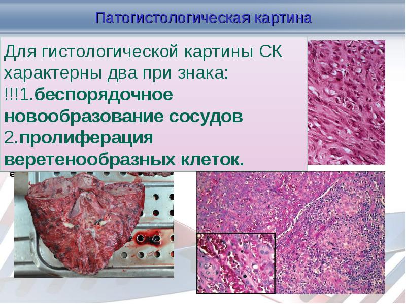 Патогистологическая картина    Гістологічно саркома Капоші – судинна пухлина,