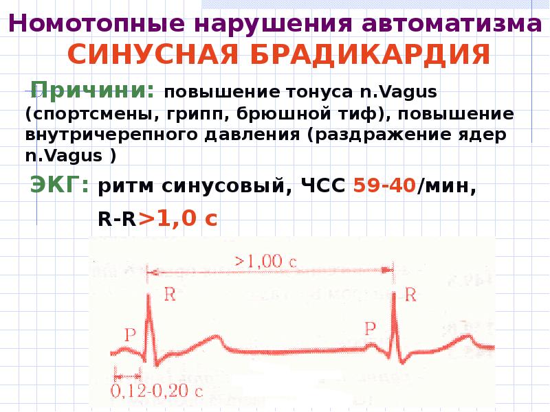 номотопные аритмии. номотопные аритмии. нарушение функции автоматизма сердца. нормоотопные нарушения ритма. нарушение автоматизма миокарда.