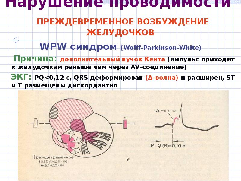 Что значит нарушение проводимости. Синдромы нарушений проводимости ЭКГ. Нарушение сердечного ритма,синдром ВПВ. Синдром нарушения проводимости сердца. Нарушение проводимости на ЭКГ.