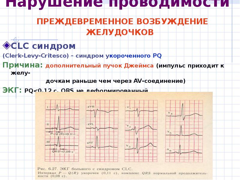 Нарушение проводимости сердца. Синдромы нарушений проводимости ЭКГ. Синдром преждевременного возбуждения желудочков на ЭКГ. Синдромы предвозбуждения желудочков CLC. Феномен преждевременного возбуждения желудочков на ЭКГ.