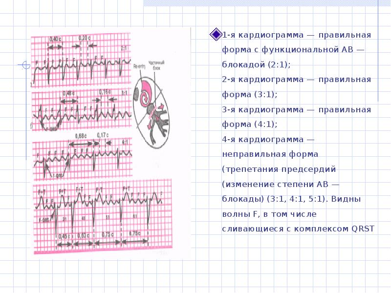 Трепетание предсердий карта вызова