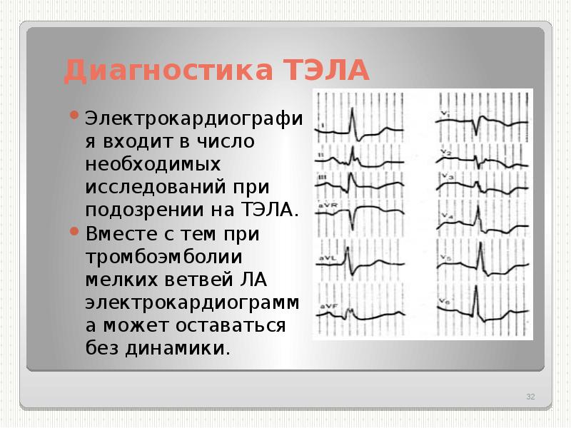 Экг при тэла фото