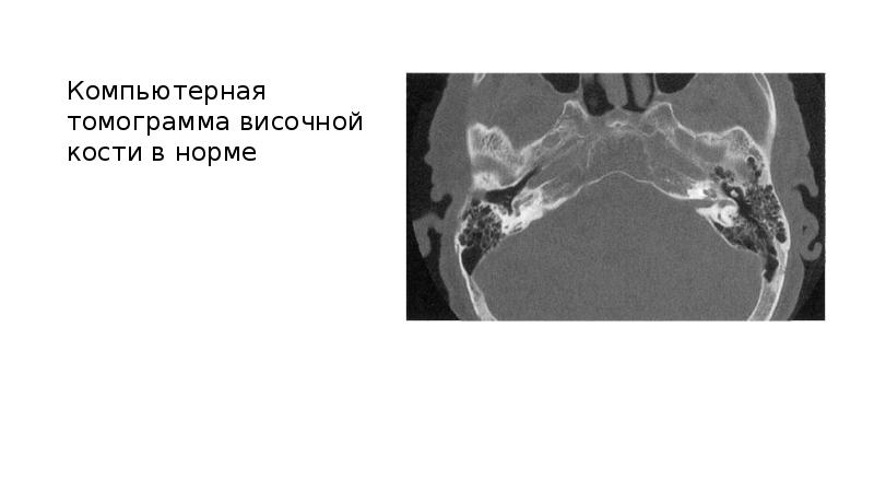 Кт височных костей