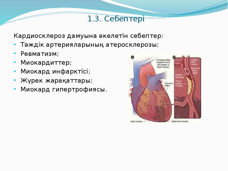 Миокард инфарктісі презентация