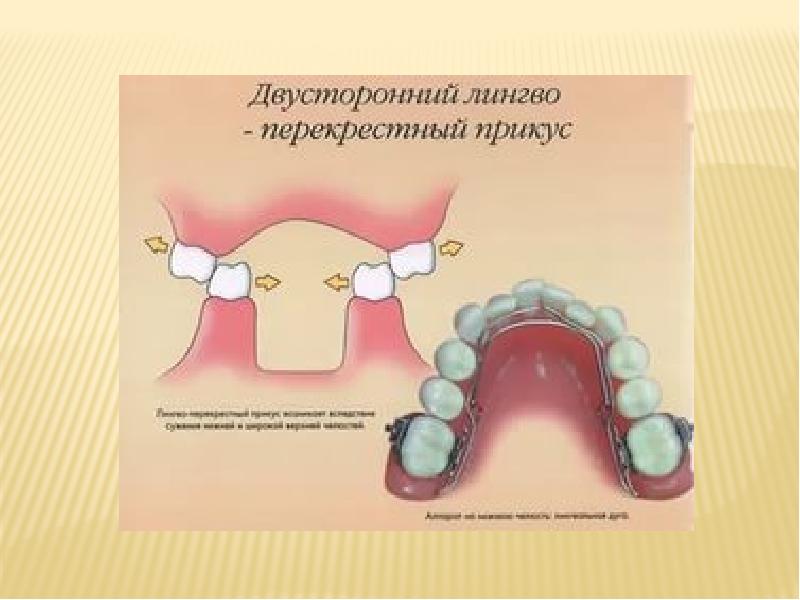 Перекрестная окклюзия