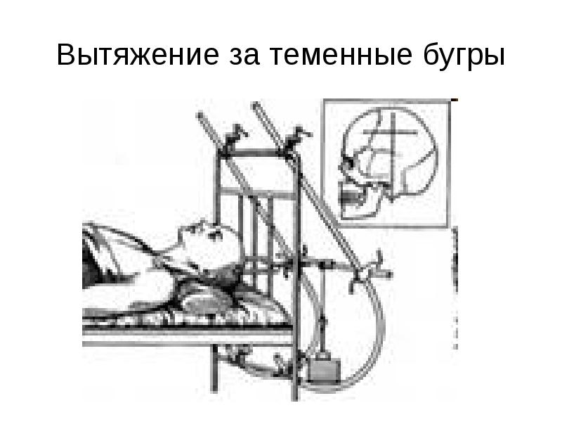 Презентация сестринский уход при травмах позвоночника