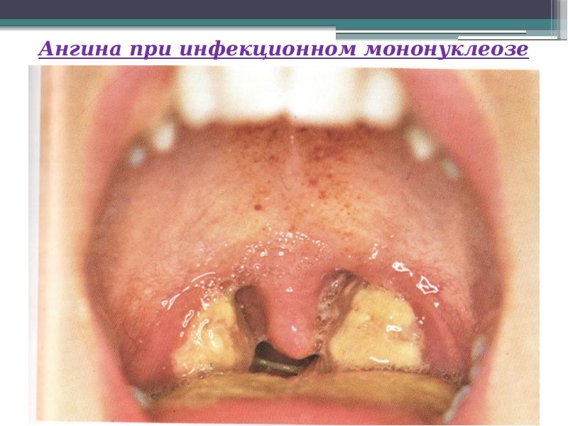 Горло при мононуклеозе фото