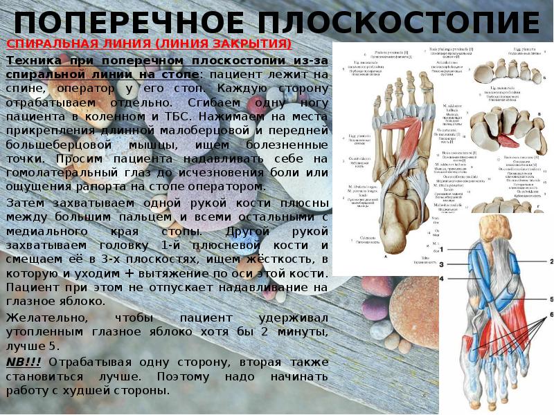 Поперечное плоскостопие. Мышца отвечающая за плоскостопие. Мышцы влияющие на плоскостопие. Мышцы стопы плоскостопие. Поперечное плоскостопие мышцы.