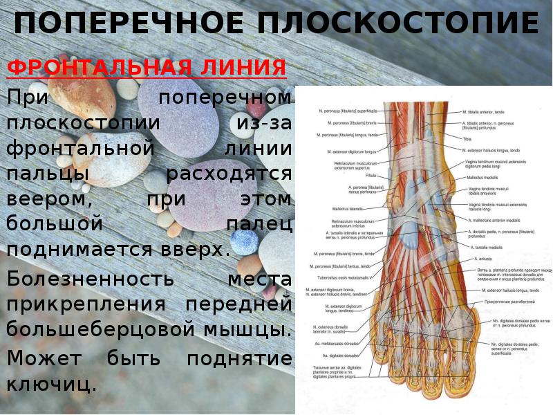 Поперечное плоскостопие. Мышца отвечающая за плоскостопие. Патогенез поперечного плоскостопия. Поперечное плоскостопие линии. Поперечное плоскостопие глубинная фронтальная линия.