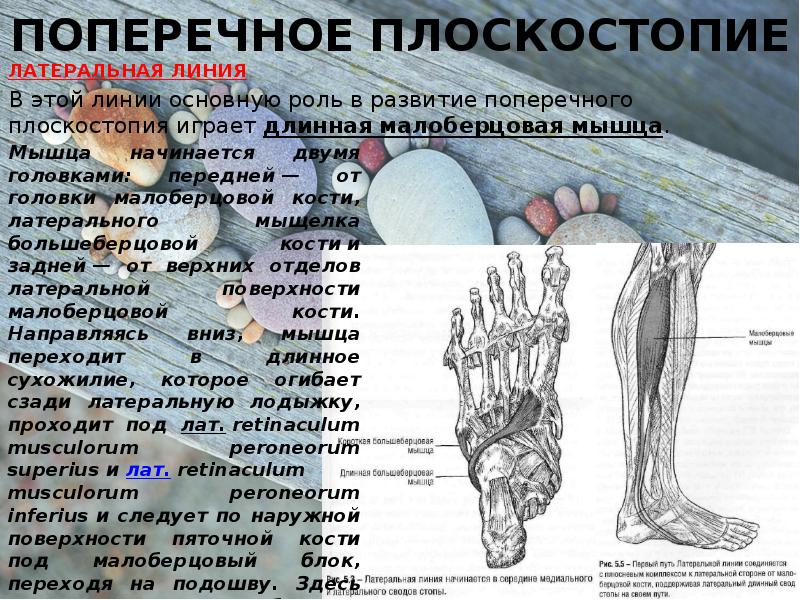 Поперечное плоскостопие степени