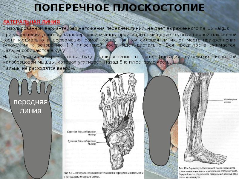 Поперечное плоскостопие степени. Поперечное плоскостопие мышцы. Плюсневые кости плоскостопие. Мышцы стопы плоскостопие. Плоскостопие вид сзади.