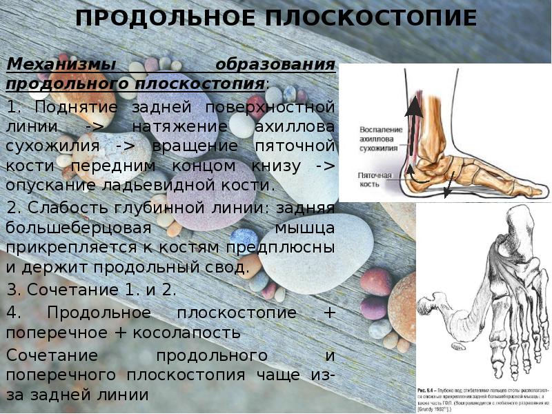 Продольное и поперечное плоскостопие