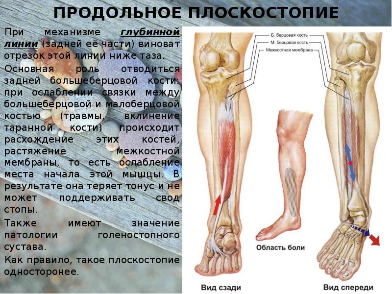 Продольное плоскостопие