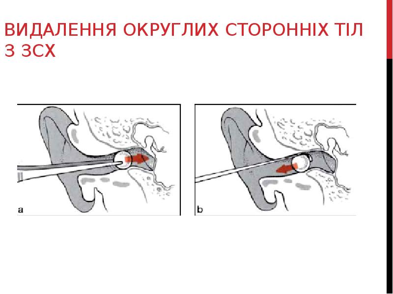 ВИДАЛЕННЯ ОКРУГЛИХ СТОРОННІХ ТІЛ З ЗСХ ВИДАЛЕННЯ ОКРУГЛИХ СТОРОННІХ ТІЛ З ЗСХ