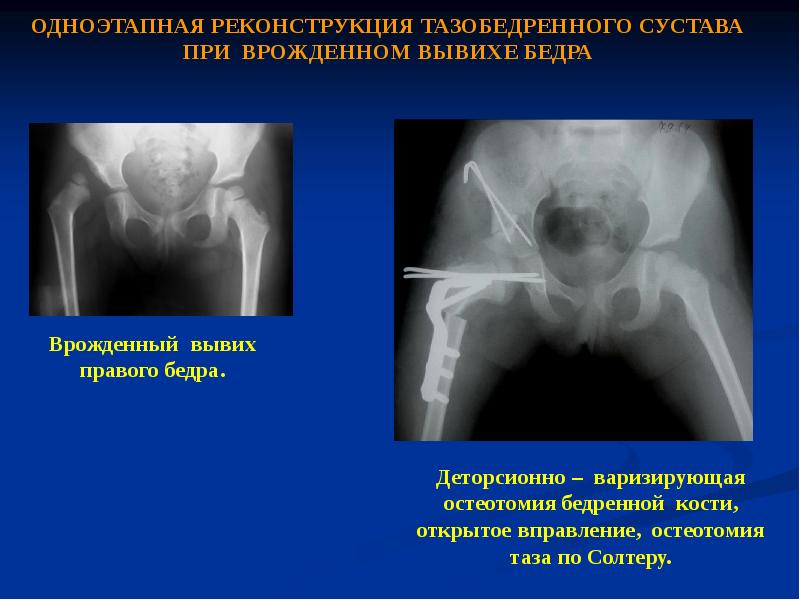 Вывих бедра презентация