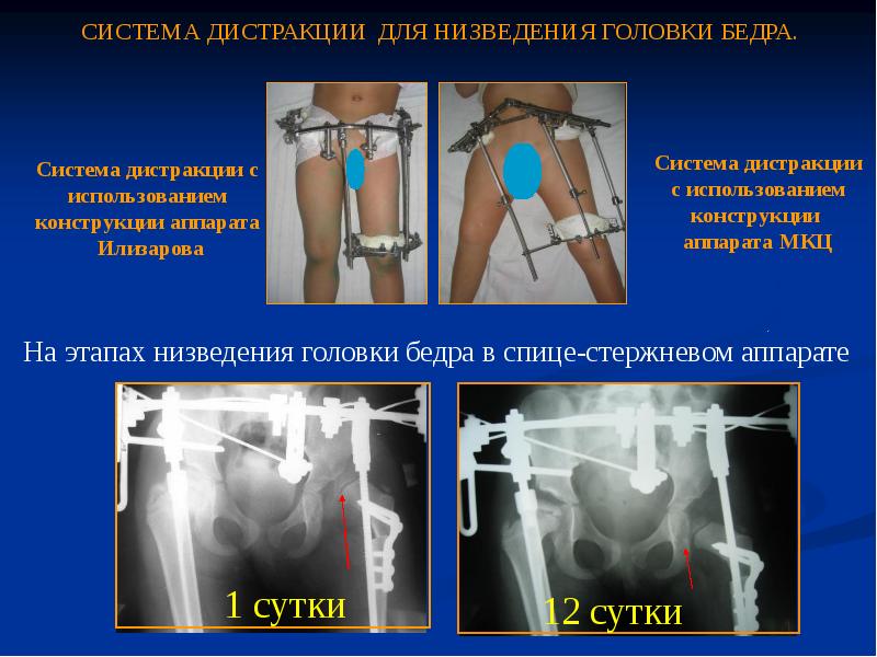 Признаки врожденного вывиха бедра. Диспластический вывих тазобедренного сустава. Система дистракции для низведения головки бедра. Операция при вывихе тазобедренного сустава. Операция врождённый вывих бедра реабилитация.