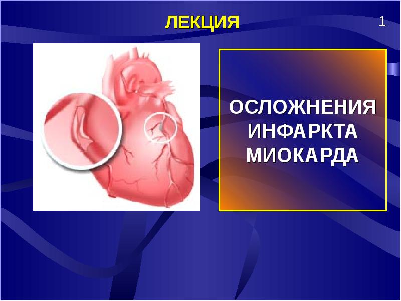 Презентация на тему осложнения инфаркта миокарда